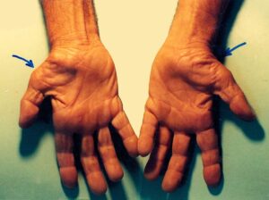 سندرم تونل کارپال،بیماری شایع تاندون دست