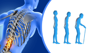 پوکی استخوان(Osteoporosis) را بیشتر بشناسید