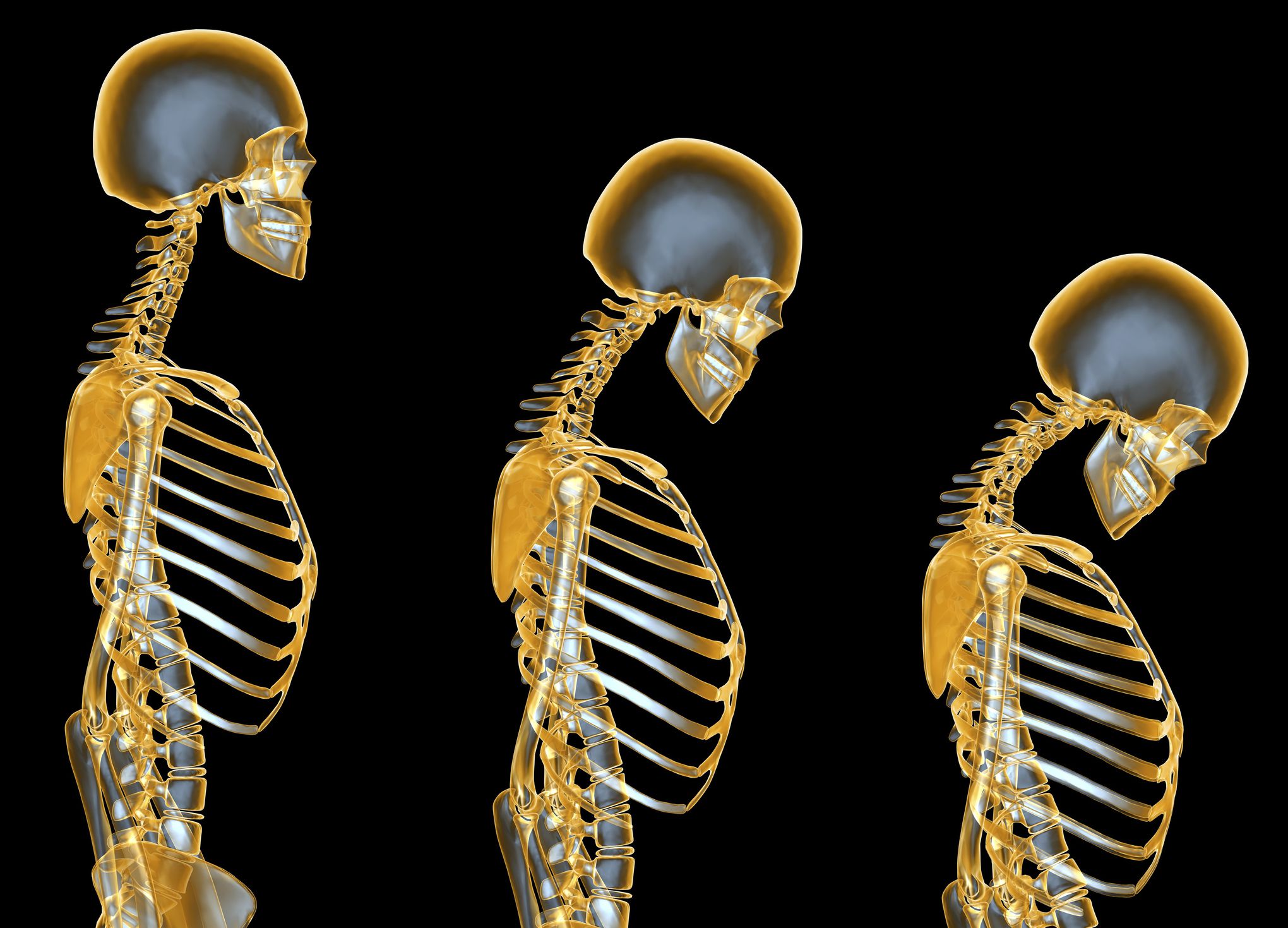 پوکی استخوان(Osteoporosis) را بیشتر بشناسید