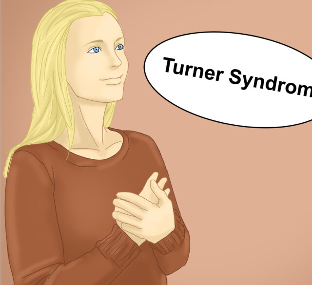 سندرم ترنر(TS)-شایع‌ترین بیماری کروموزم جنسی زنان